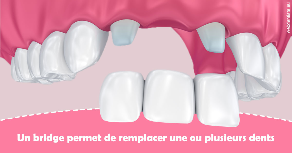 https://dr-ricci-anne-marie.chirurgiens-dentistes.fr/Bridge remplacer dents 2