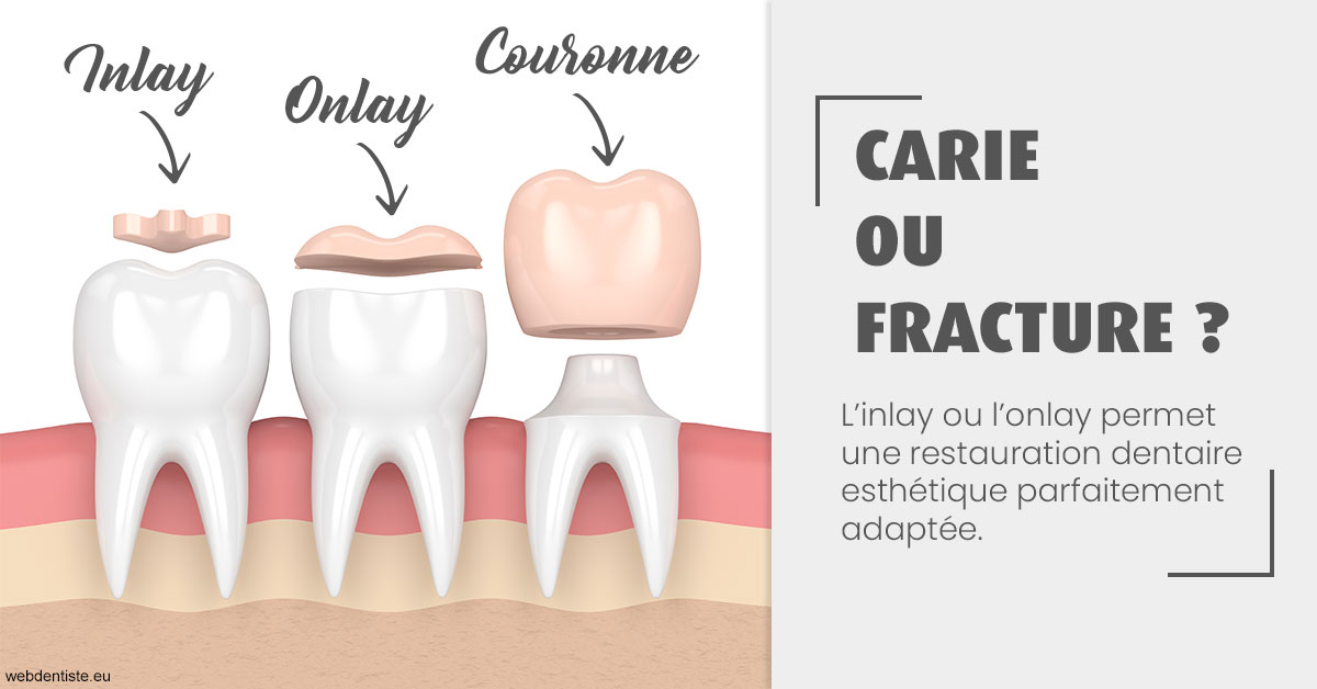 https://dr-ricci-anne-marie.chirurgiens-dentistes.fr/T2 2023 - Carie ou fracture 1