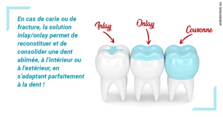 https://dr-ricci-anne-marie.chirurgiens-dentistes.fr/L'INLAY ou l'ONLAY