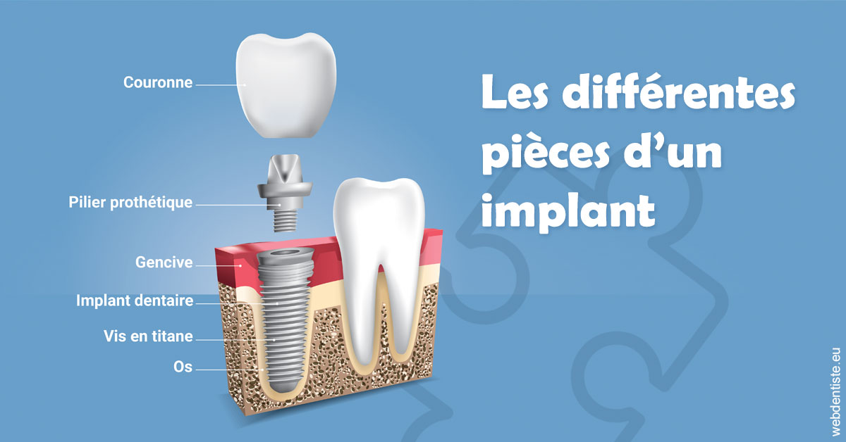 https://dr-ricci-anne-marie.chirurgiens-dentistes.fr/Les différentes pièces d’un implant 1